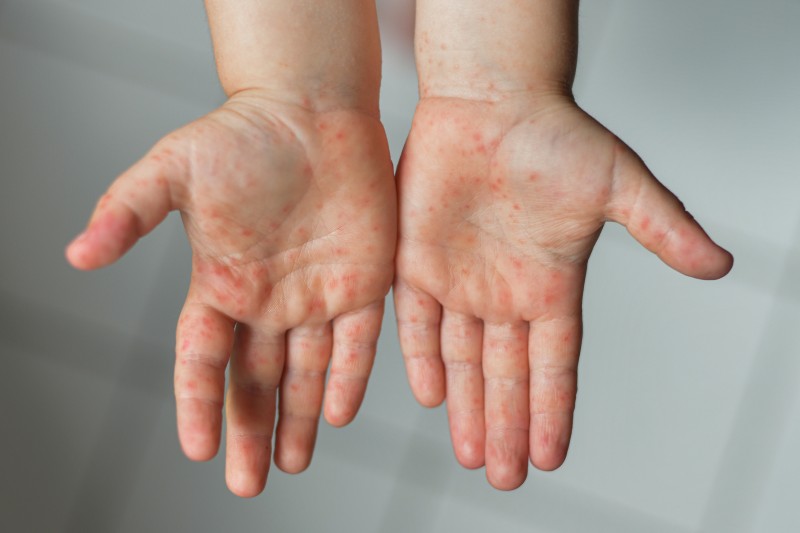 A child's hands with hand, foot, and mouth disease rash bumps.