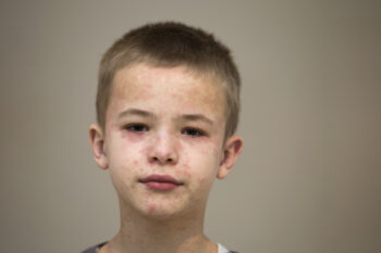 Boy with measles covering his face