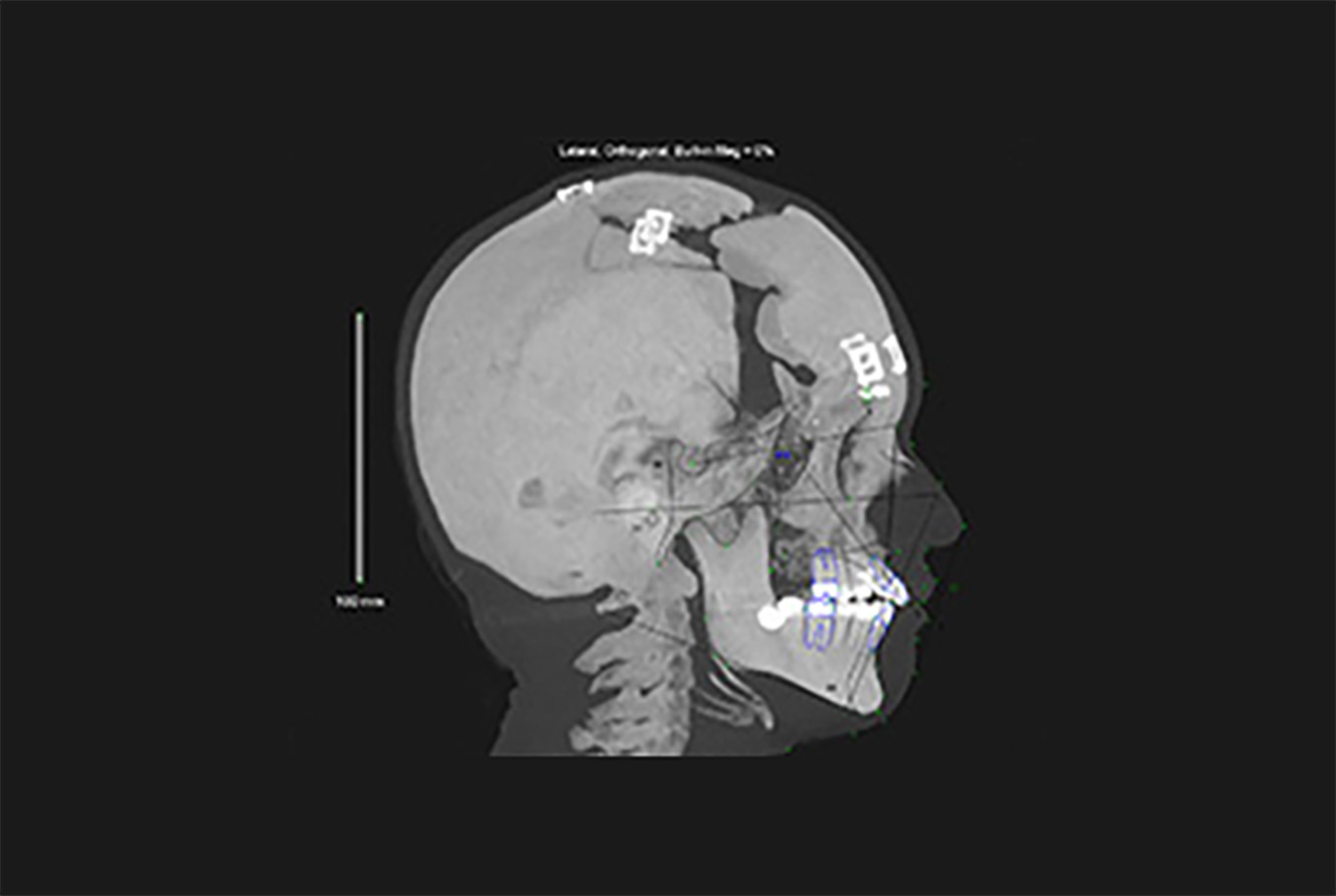 Imaging of a child's skull