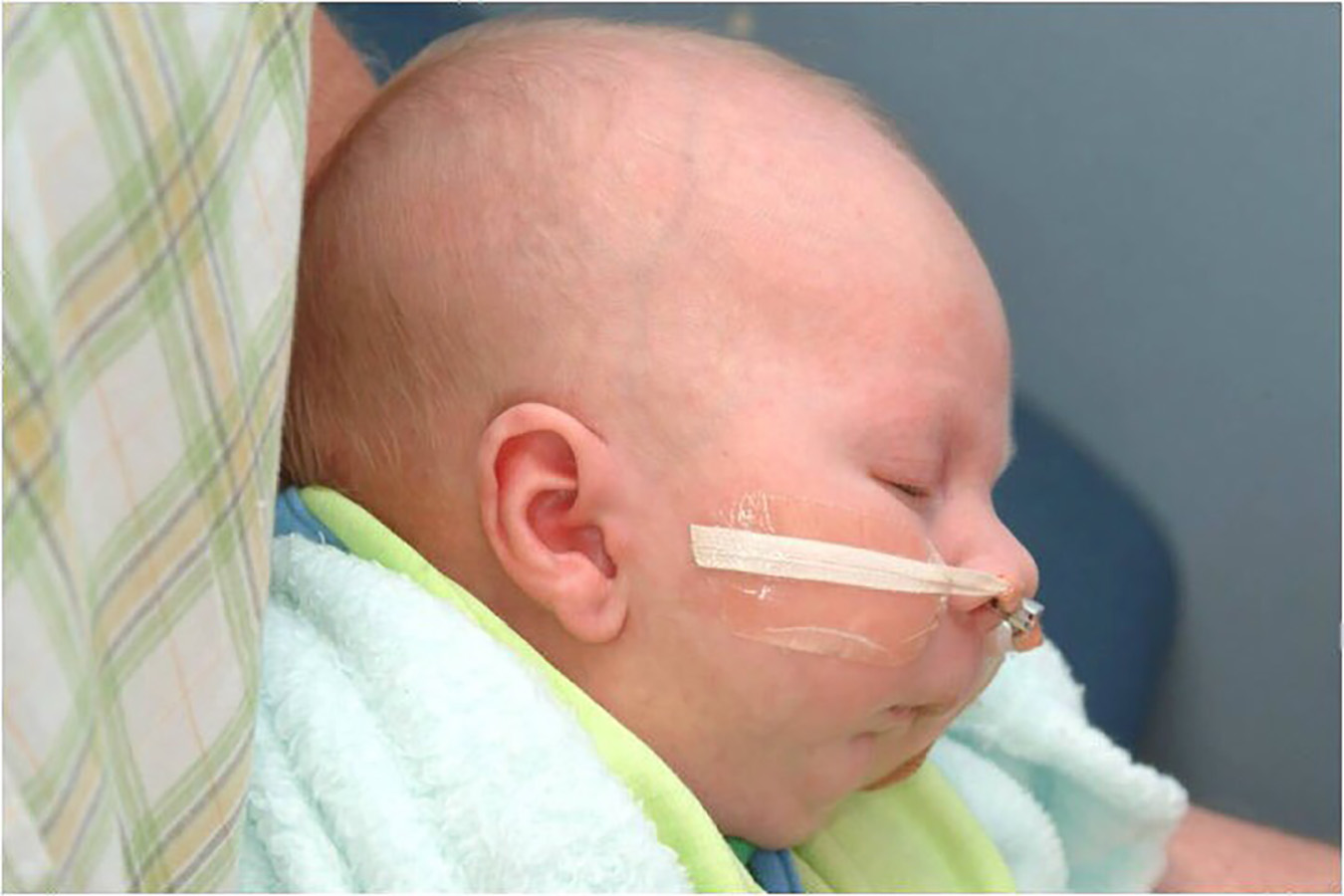 A baby with a breathing tube