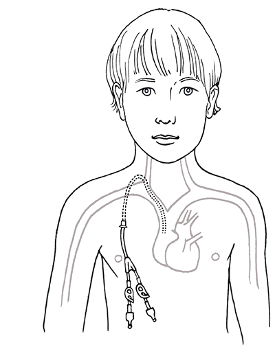 Illustration of a Hickman double lumen central venous catheter