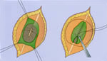 Closing the defect in spina bifida. Reprinted from 'Principles of Neurosurgery,' 2nd edition, edited by Setti S. Rengachary, Richard G. Ellenbogen. Copyright 2005, with permission from Elsevier