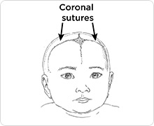 coronal sutures