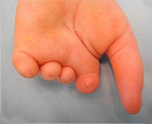 Hand of a child with short fingers and a typical-size thumb