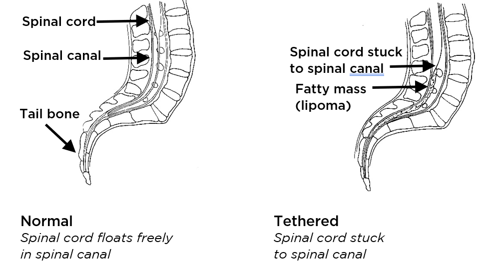 An illustration of the difference between normal and tethered spinal cords